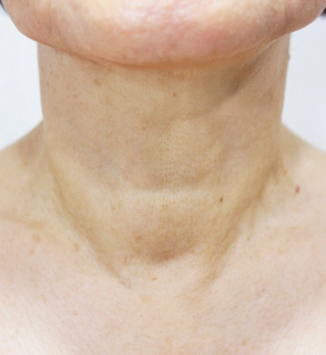 Korean neck lift after photo with smoother neckline, tightened skin, and reduced wrinkles.