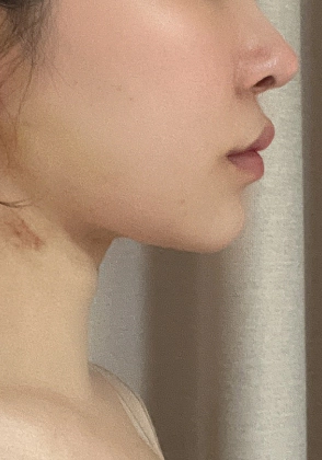 Sharp jawline and no double chin after Korean jawline lifting surgery.