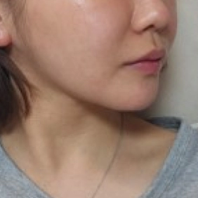 Patient 1 month after Korean double chin and Korean jawline lifting surgery.