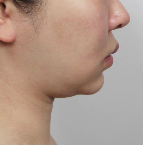 Female with a lot of double chin fat.