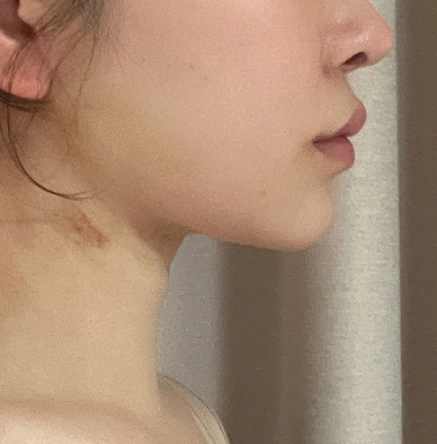 No double chin after fat removal and Korean jawline lifting surgery.