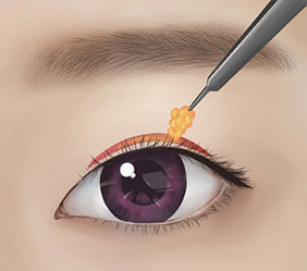 눈위의 불룩한 지방 제거.