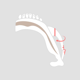 Facial contouring zygoma rotation method.