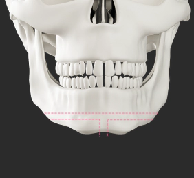 Male facial contouring genioplasty for long chin.