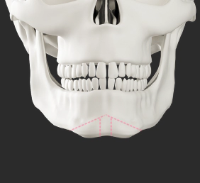 Male facial contouring genioplasty for wide chin.
