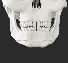 Male facial contouring genioplasty for short chin.