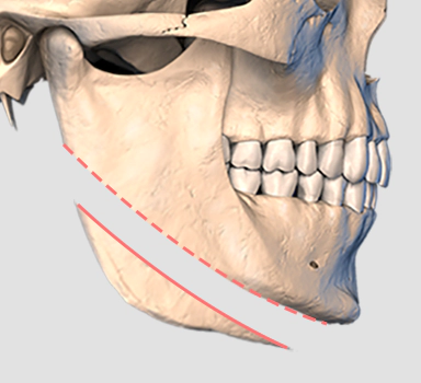 Male facial contouring long curved osteotomy method.