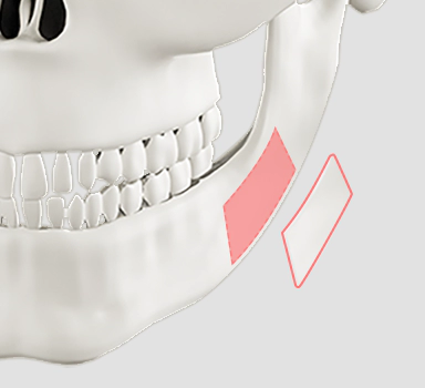 Male facial contouring cortical bone osteotomy method.