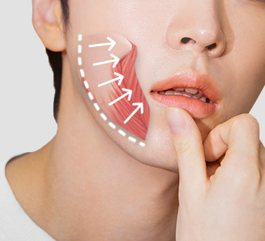 Male facial contouring massetor muscle botox.