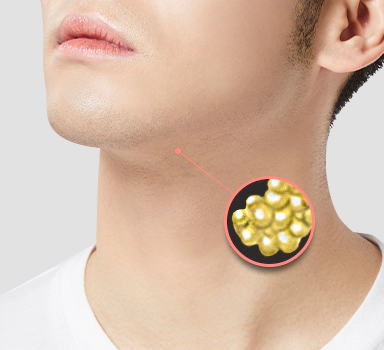 Male facial contouring double chin fat removal.