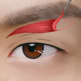 Subbrow lift incision line.