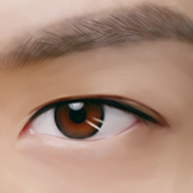 Sagging eyelid lifted after subbrow lift surgery.