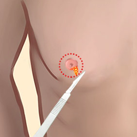 Removing breast tissue with gynecomastia surgery.