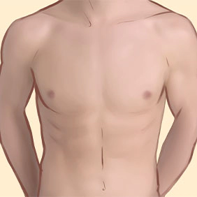 Male with flat chest after gynecomastia surgery.