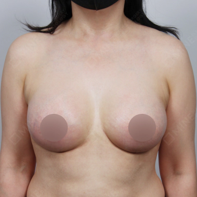 Volumized breast with implant and Korean breast lift procedure.
