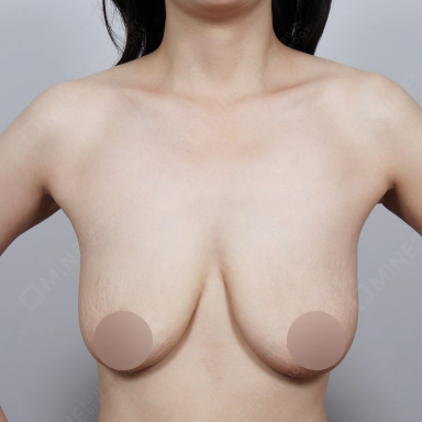 Breast that are sagging and flat before Korean breast lift.
