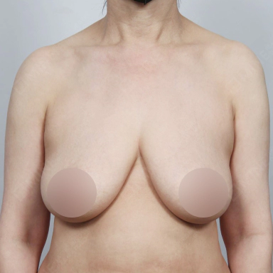 Breast that need reduction and lifting with Korean breast lift.