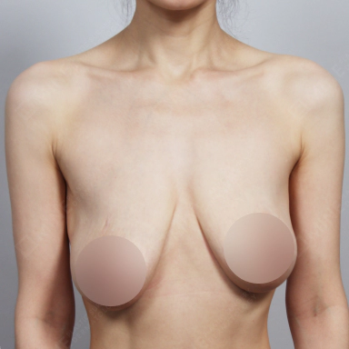 Breast with asymmetric sagging before Korean breast lift.