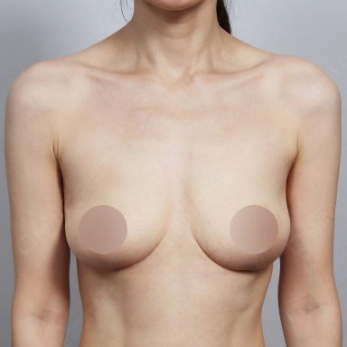 Breast that lifted equally after Korean breast lift.