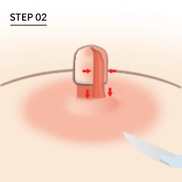 유두축소시 너비와 높이를 줄이는 절개.