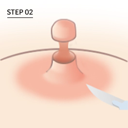 유두 축소시 안의 유관과 신경 보존.