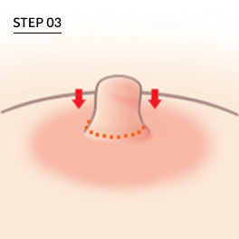 유두 높이 줄임.