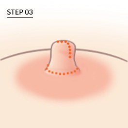 유두 축소술시 봉합이 끈나서 유두의 길이와 폭을 줄임.