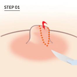 For Korean nipple reduction, partially remove some of the nipple.