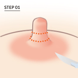 유두의 높이만 줄이는 유두 축소 절개.