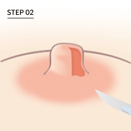 유두 축소시 너비만 줄이는 수술 절개.