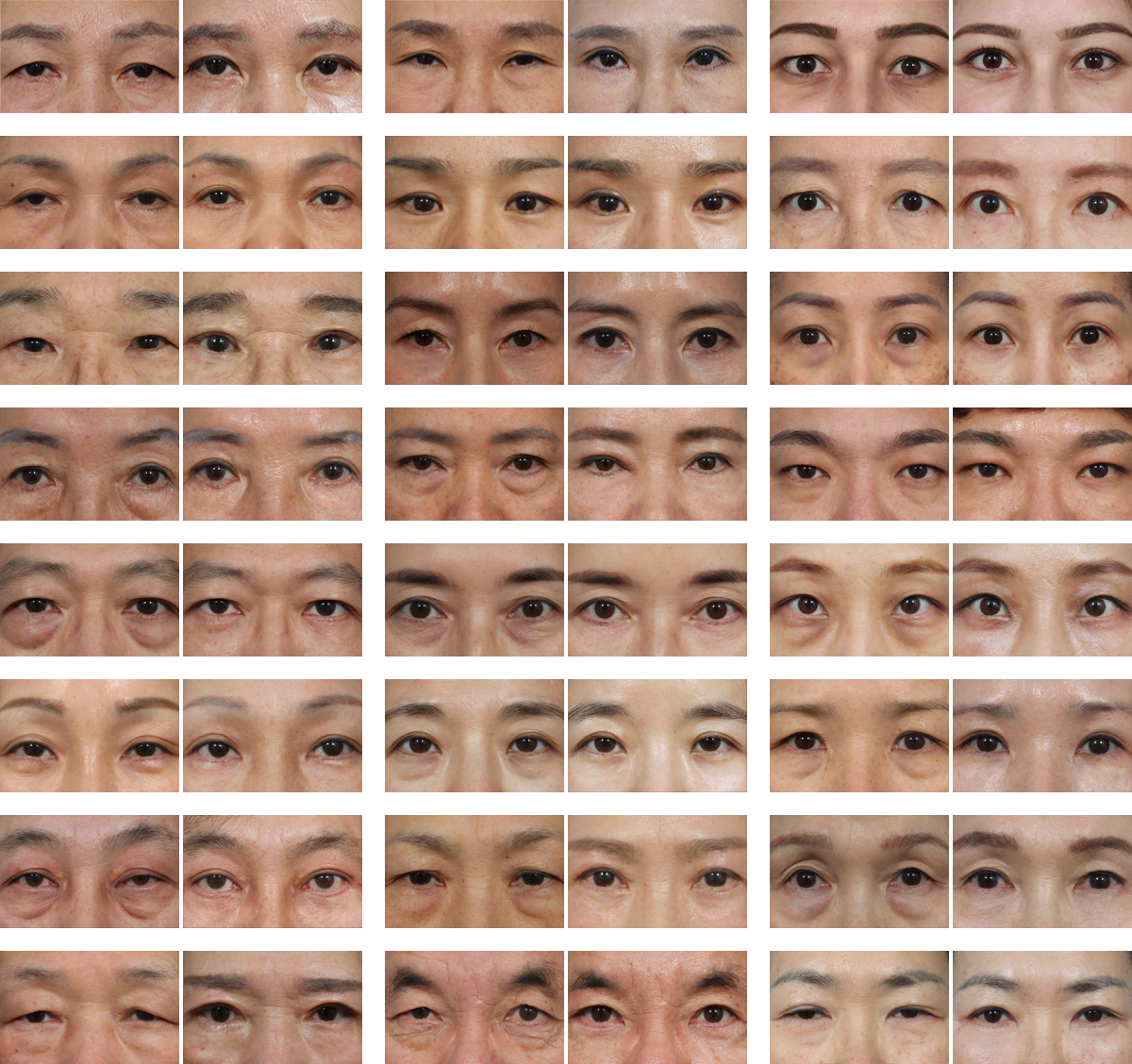 Many before and after of lower blepharoplasty surgery.