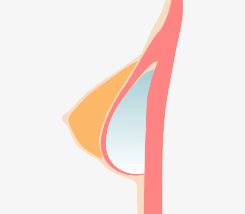 Image of breast that is lifted through the Korean breast lift dual plane effect.