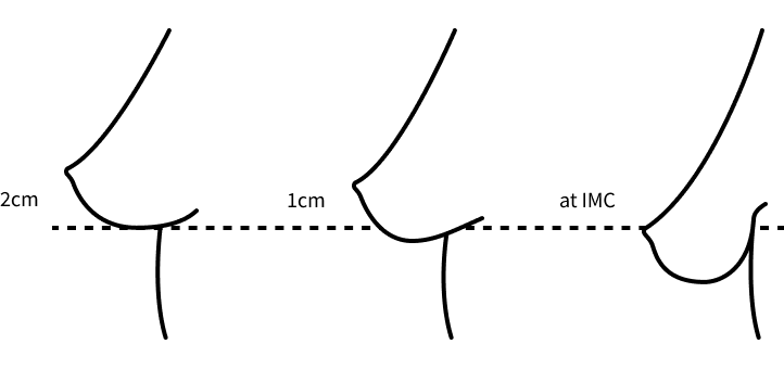 Korean breast lift stage 1 sagging graph.
