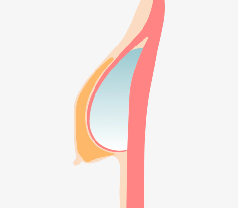Image of Sagging Breast before Korean breast lift.