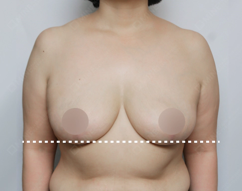 Lifted breast after Korean breast lift.