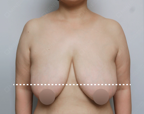 Sagging breast below the inframmary line that needs Korean breast lift.