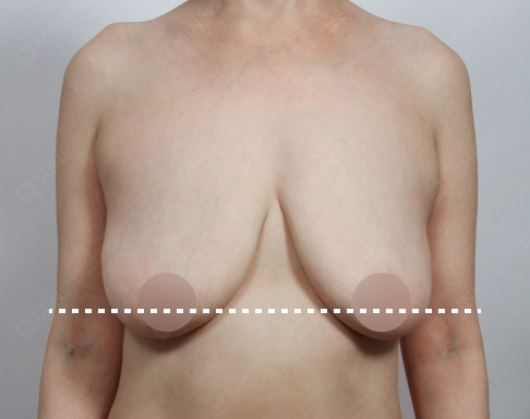 Stage 2 sagging breast that need Korean breast lift surgery.
