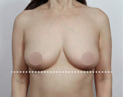 Stage 2 breast sagging case after breast lift surgery.