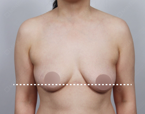 Breast with slight sagging before Korean breast lift.