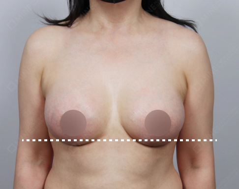 Korean breast lift result photo showing lifted breasts with improved shape and higher nipple position.