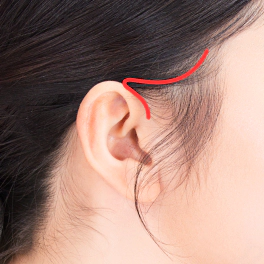 Red line showing the incision area for a mini facelift.