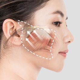 Direction of SMAS pull for facial lifting.