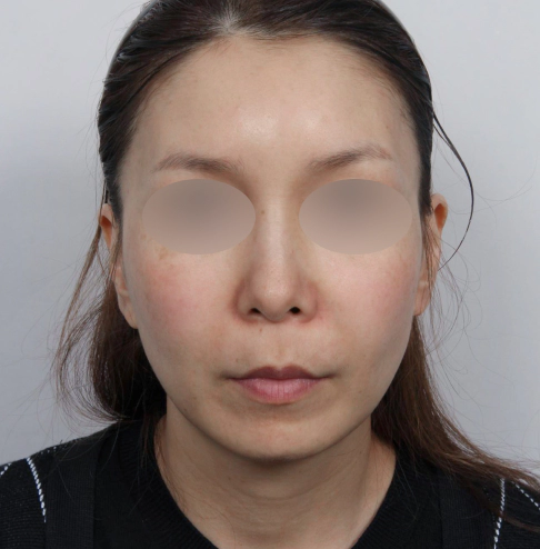 Woman visiting the dermatology clinic for facial redness and pigmentation.