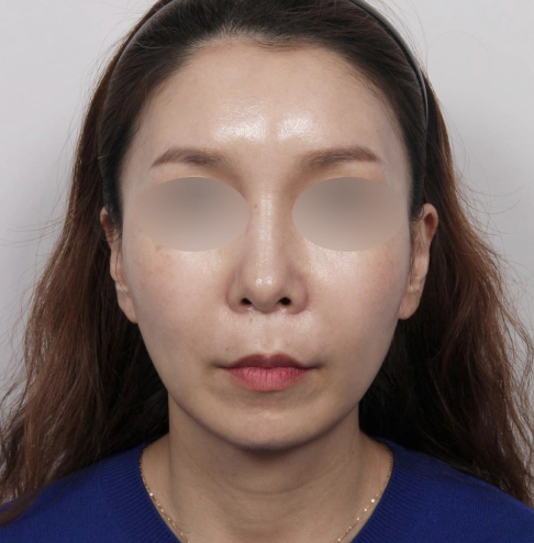 Woman with reduced blemishes and melasma after laser treatment at the dermatology clinic.