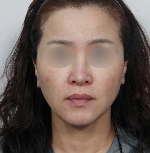 Woman with melasma, pigmentation, and blemishes on the face.
