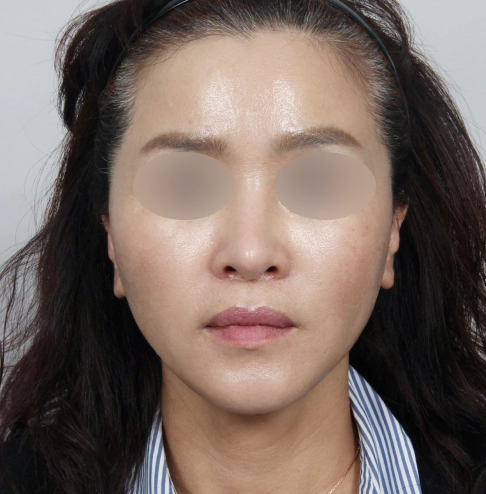 Woman with improved pigmentation after laser treatment.