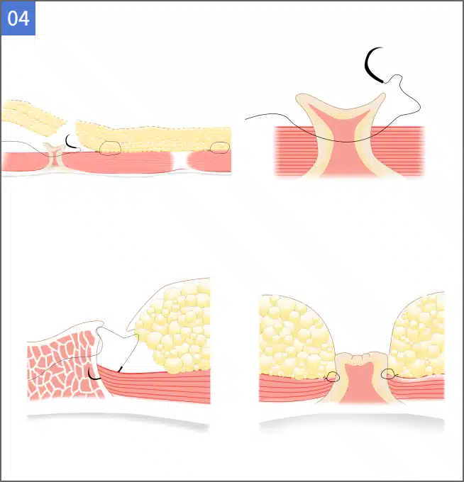 Technique for creating a new umbilicus in abdominoplasty.
