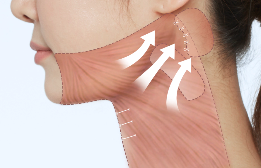 활경근을 당겨서 턱을 감싸서 목거상을 하는 방법.