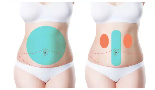 Liposuction areas and skin incision sites in abdominoplasty.