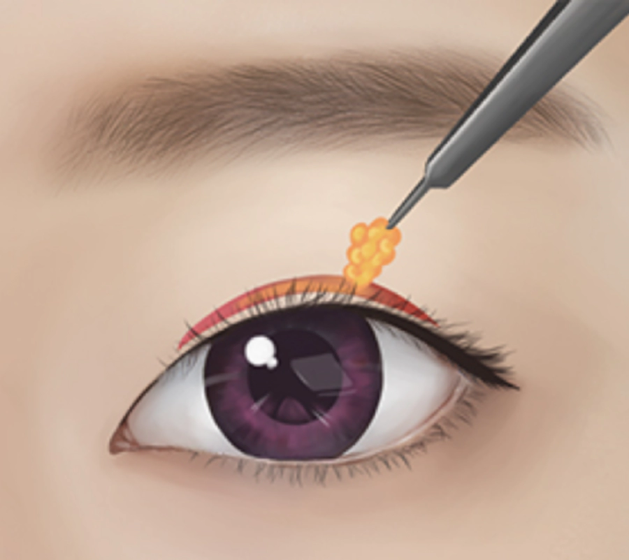 부분절개로 남자 눈위의 볼륨을 줄이는 방법.